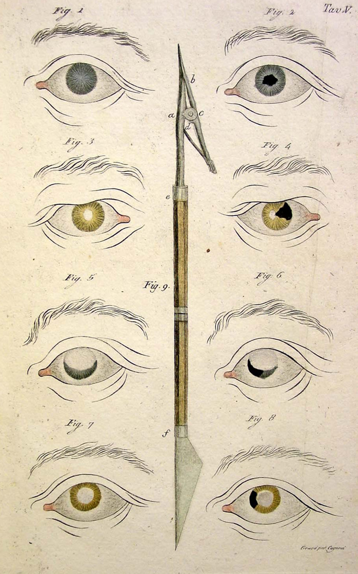 Hand-colored copper engraving from Assalini's Ricerche sulle pupille artificiali, 1811