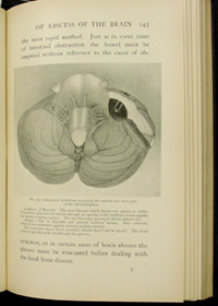 Illustration from Ballance's 'Some points in the surgery of the brain and its membranes,' 1907
