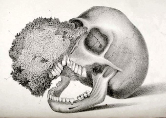 Ossific tumor, as illustrated in Joseph Fox's 'The natural history and diseases of the human teeth,' 1846