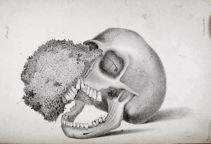 Ossific tumor, as illustrated in Joseph Fox's 'The natural history and diseases of the human teeth,' 1846