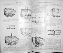 Illustrations from Nicholas Senn's 1893 article on enterorrhaphy