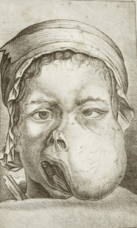 Tumor, as illustrated in Jourdain's 1778 'Treatise on the Diseases and Surgical Operations of the Mouth'