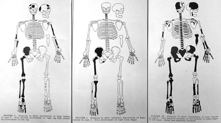 Illustrations showing bone lesions from Fuller Albright's 1937 article in the "New England Journal of Medicine"