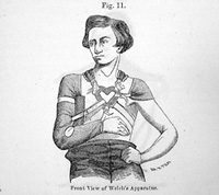 Welch's apparatus for the treatment of fractured clavicles, from "Transactions of the American Medical Association," 1855