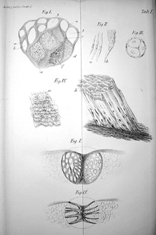 Illustration from Rudolf Virchow's 1847 article on cancer