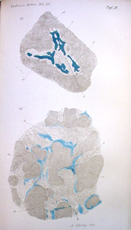 Illustration from Heinrich Waldeyer-Hartz's 1872 article on the epithelial origin of cancer