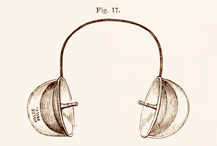 Illustration of Itard auricles